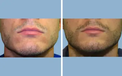 Before and After